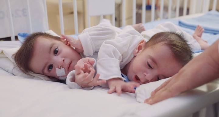 فصل التوأم السيامي العراقي علي وعمر في السعودية